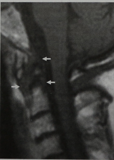 Снимки МРТ и КТ. Ревматоидный артрит