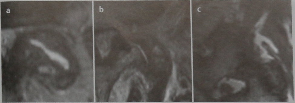 Снимки МРТ и КТ. Дегенеративные изменения дугоотростчатых суставов