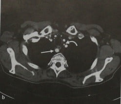 Снимки МРТ и КТ. Аберрантная левая подключичная артерия 