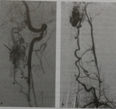 Снимки МРТ и КТ. Артериовенозная фистула твердой оболочки спинного 