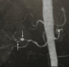 Снимки МРТ и КТ. Фиброзно-мышечная дисплазия 