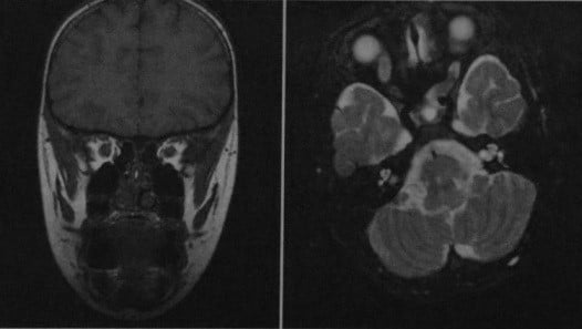 Снимки МРТ и КТ. Глиома зрительного нерва