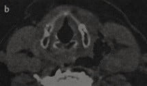 Снимки МРТ и КТ. Перелом щитовидного хряща