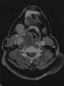 Снимки МРТ и КТ. Рак щитовидной железы