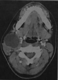 Снимки МРТ и КТ. Бранхиогенная киста
