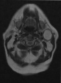 Снимки МРТ и КТ. Бранхиогенная киста