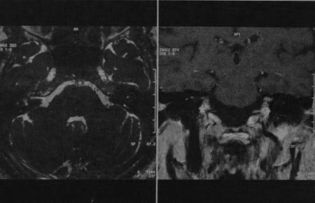 Снимки МРТ и КТ. Поражение лицевого нерва