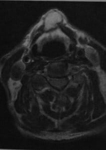 Снимки МРТ и КТ. Щитовидно-язычная киста