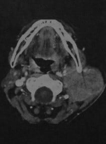 Снимки МРТ и КТ. Рак слюнных желез