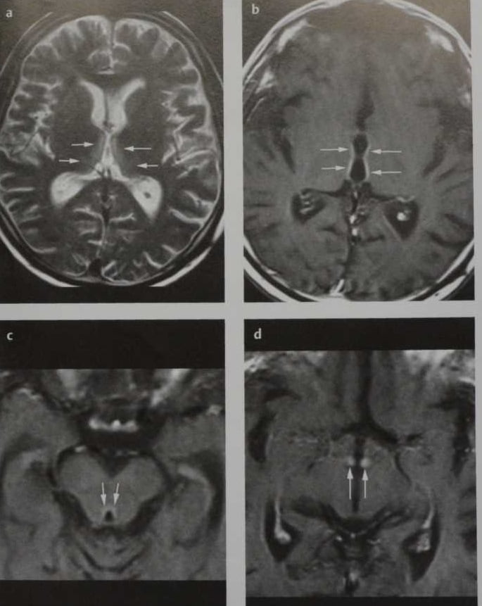 Снимки МРТ и КТ. Энцефалопатия Вернике