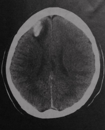 Снимки МРТ и КТ. Ушиб головного мозга
