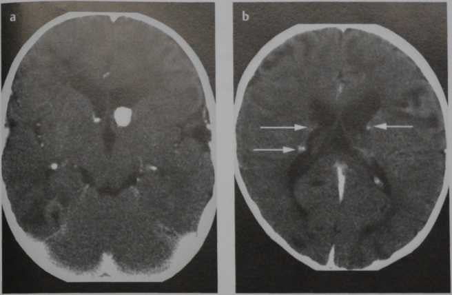 Снимки МРТ и КТ. Туберозный склероз (болезнь Бурневиля-Прингла)