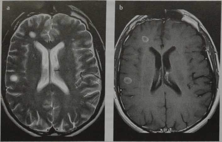 Снимки МРТ и КТ. Постинфекционный энцефаломиелит (ОДЭМ)