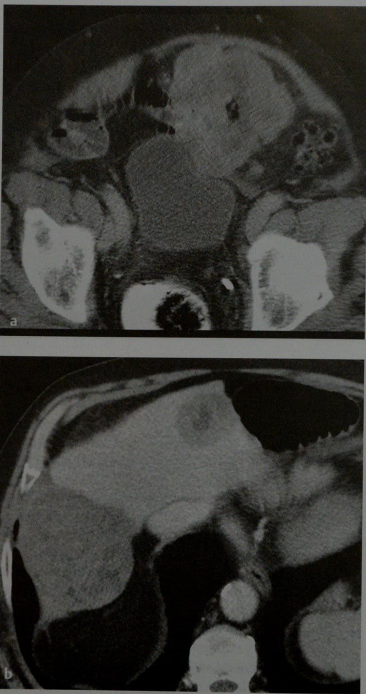 Снимки МРТ и КТ. Гастроинтестинальная стромальная опухоль (GIST)