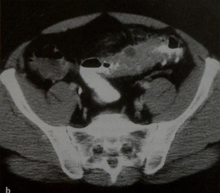 Снимки МРТ и КТ. Дивертикулит толстого кишечника