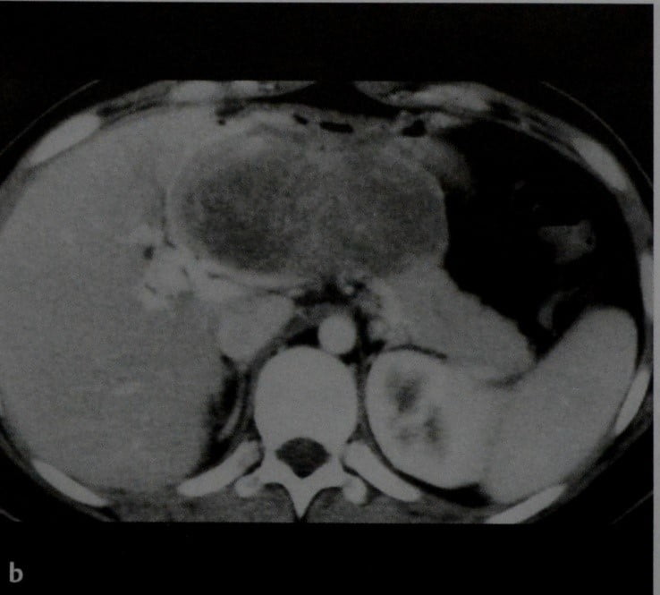 Снимки МРТ и КТ. Солидная псевдопапиллярная опухоль