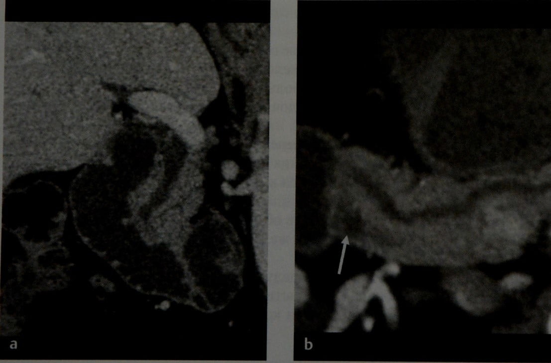 Снимки МРТ и КТ. Разделенная поджелудочная железа