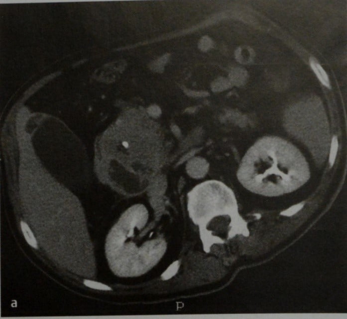 Снимки МРТ и КТ. Лимфома поджелудочной железы