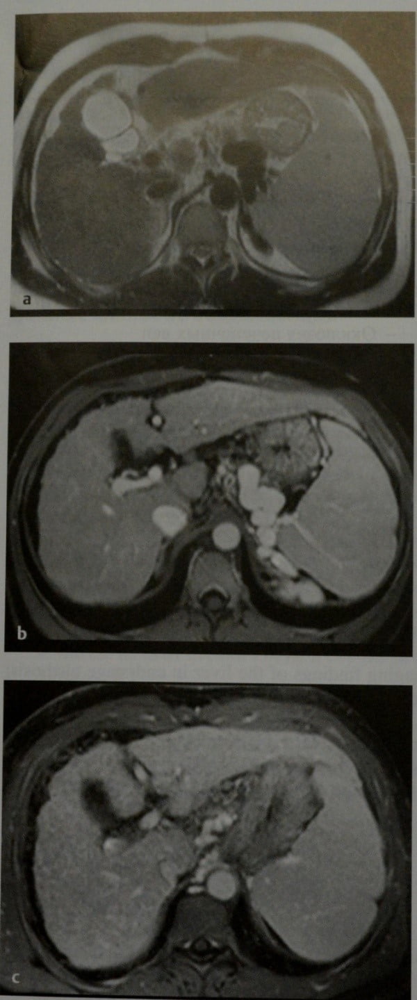 Снимки МРТ и КТ. Цирроз печени