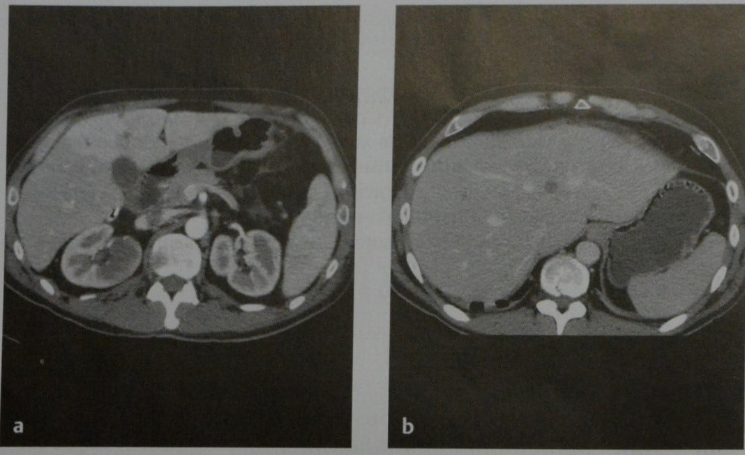Снимки МРТ и КТ. Лимфома печени
