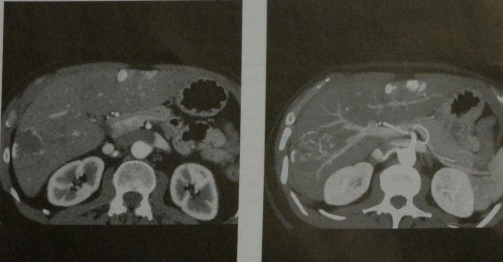 Снимки МРТ и КТ. Кавернозная гемангиома