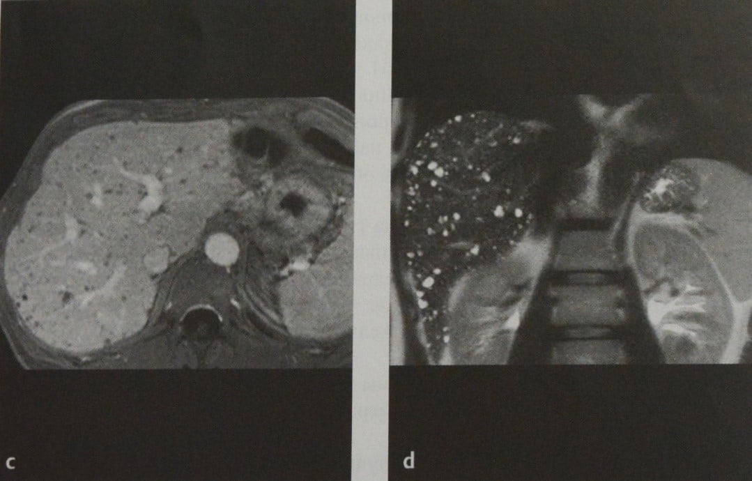 Снимки МРТ и КТ. Билиарные гамартомы (комплексы фон Мейенбурга)