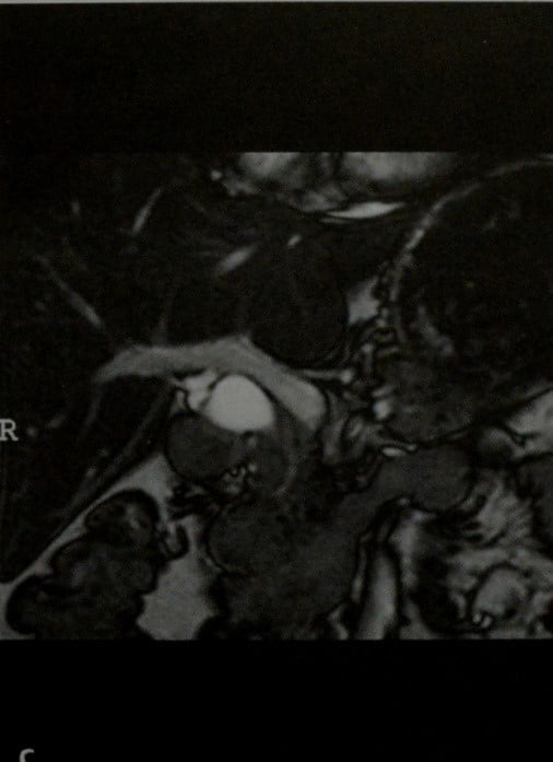Снимки МРТ и КТ. Киста общего желчного протока