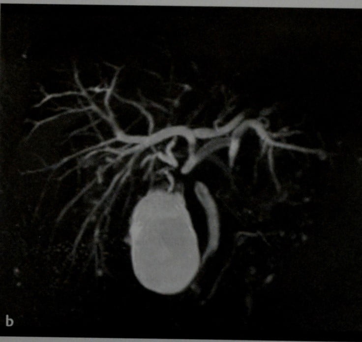 Снимки МРТ и КТ. Внепеченочная карцинома желчного протока