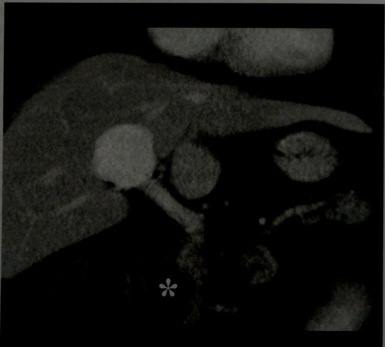 Снимки МРТ и КТ. Дивертикулы двенадцатиперстной кишки