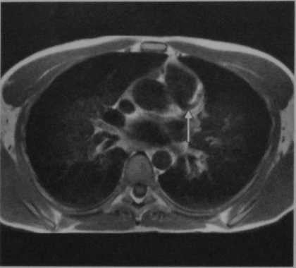 Снимки МРТ и КТ. Синдром Бланда-Уайта-Гарланда