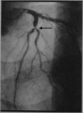 Снимки МРТ и КТ. Ишемическая болезнь сердца