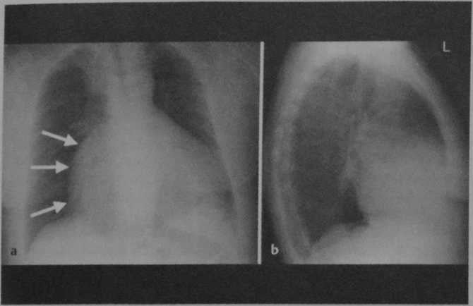Снимки МРТ и КТ. Недостаточность трикуспидального клапана