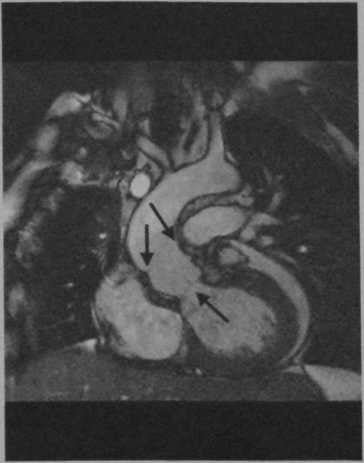 Снимки МРТ и КТ. Протезирование аортального клапана по Россу