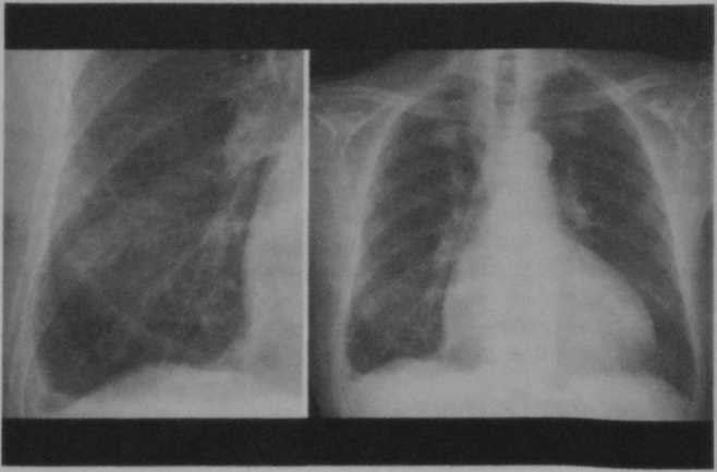 Снимки МРТ и КТ. Хроническая сердечная недостаточность