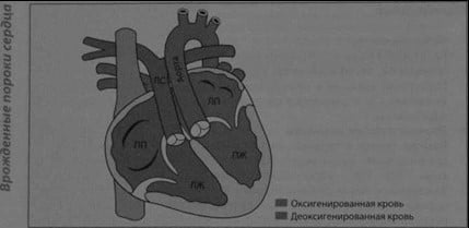 Снимки МРТ и КТ. Корригированная транспозиция крупных артерий