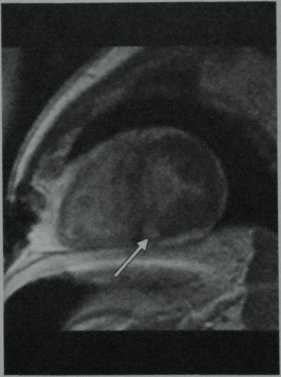 Снимки МРТ и КТ. Атрезия клапана легочного ствола