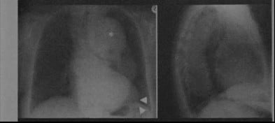 Снимки МРТ и КТ. Аневризма аорты