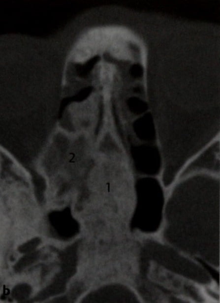 Снимки МРТ и КТ. Полиоссальная фиброзная дисплазия