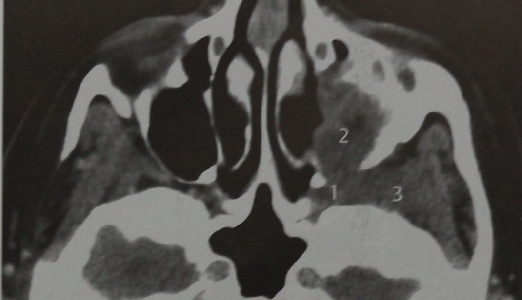 Снимки МРТ и КТ. Злокачественные опухоли крыловидно-нёбной ямки