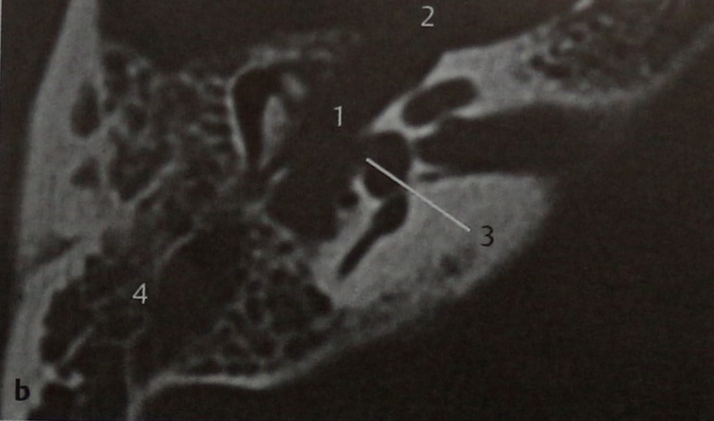 Снимки МРТ и КТ. Шваннома лицевого нерва