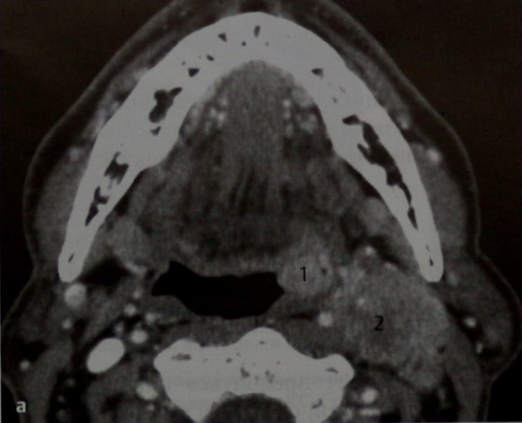 Снимки МРТ и КТ. Рак нёбной миндалины