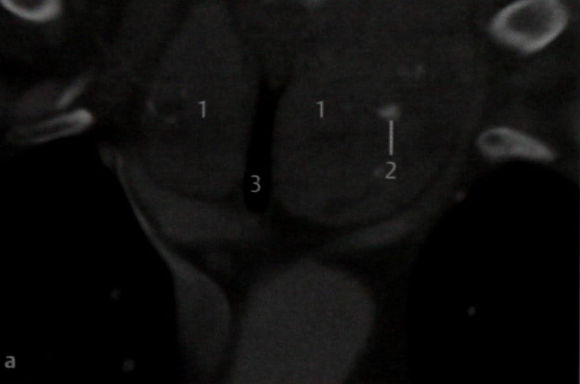 Снимки МРТ и КТ. Гипертрофия щитовидной железы и зоб