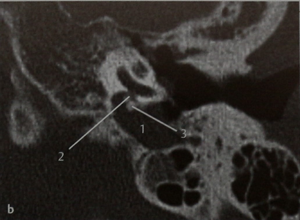 Снимки МРТ и КТ. Врожденная холестеатома