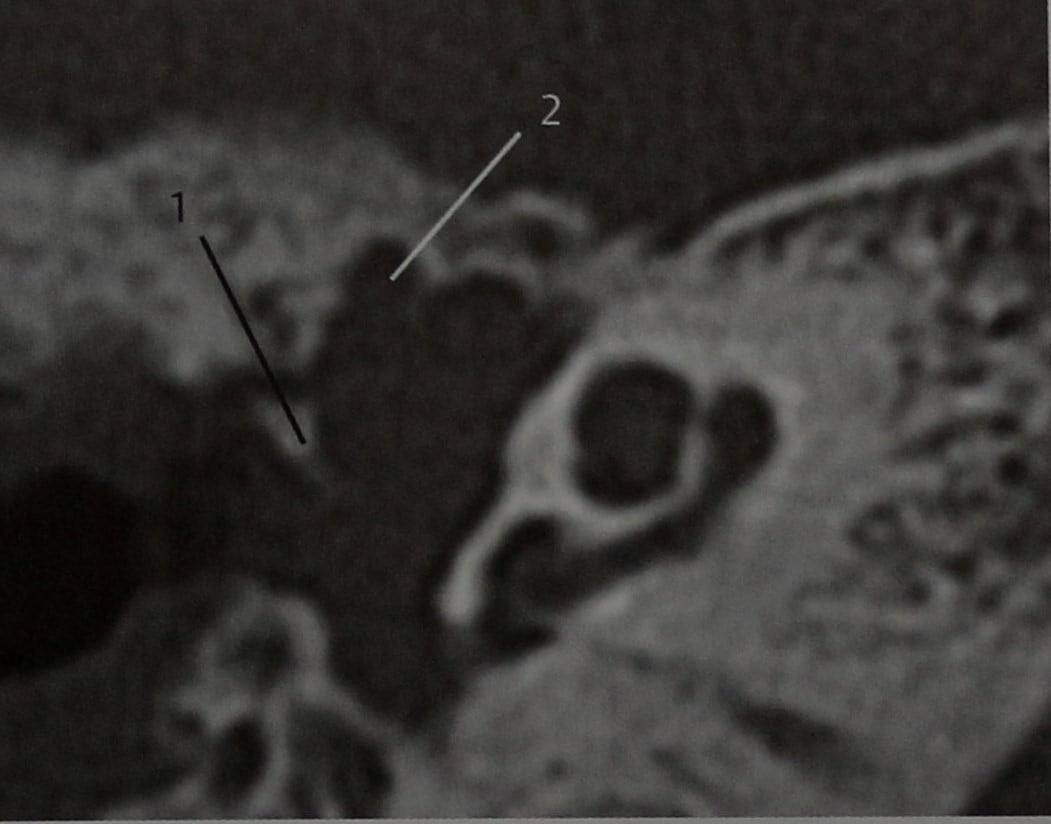 Снимки МРТ и КТ. Аденома среднего уха