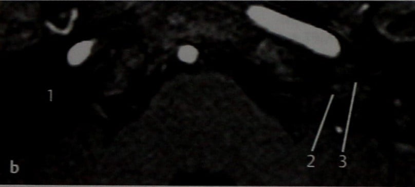 Снимки МРТ и КТ. Лабиринтит и менингит со стертой клиникой