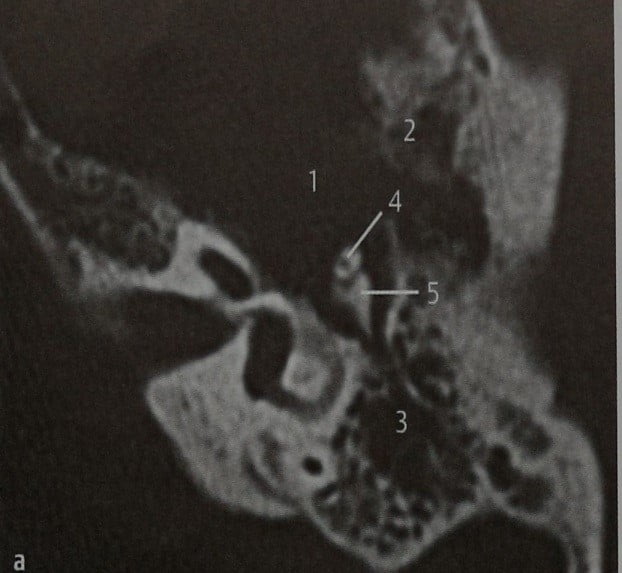 Снимки МРТ и КТ. Злокачественная опухоль наружного слухового проход