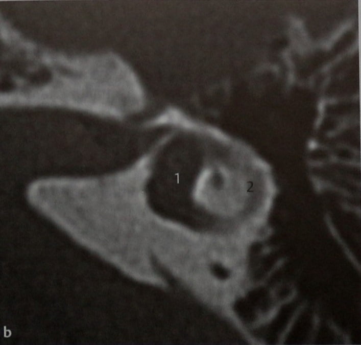 Снимки МРТ и КТ. Оссификация лабиринта после менингита