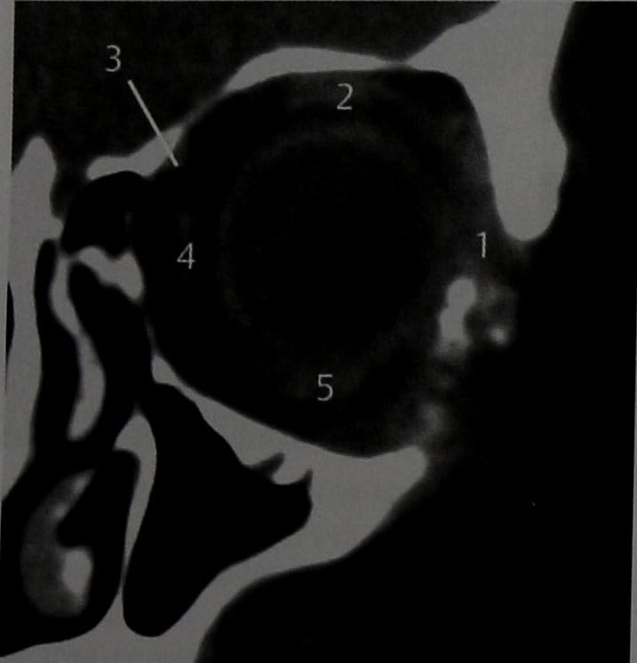 Снимки МРТ и КТ. Амилоидоз глазницы