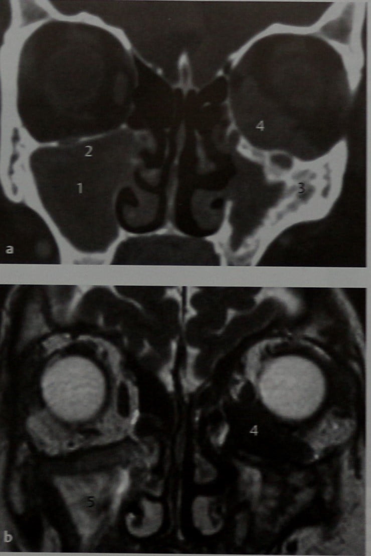 Снимки МРТ и КТ. Гранулематоз Вегенера с вовлечением в процесс глаз
