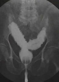 Снимки МРТ и КТ. Состояние мочевыводящей системы после операции